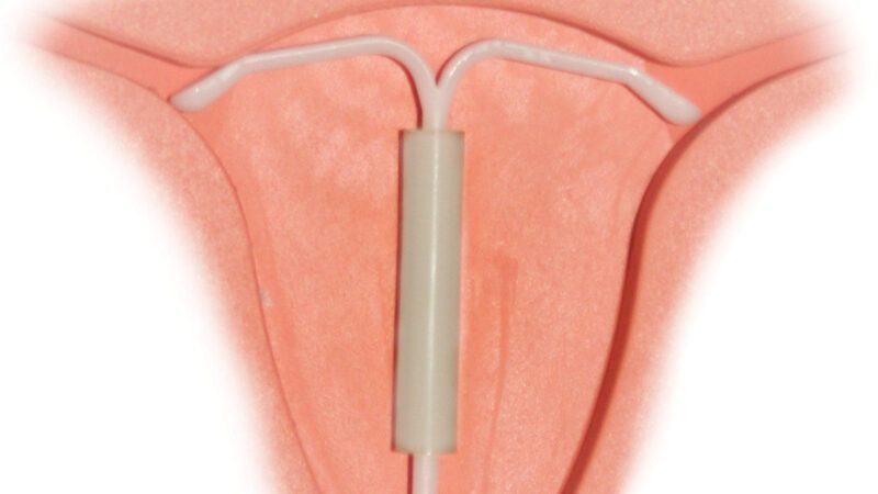 Plano de saúde vai ter de pagar o DIU hormonal de quem tem endometriose