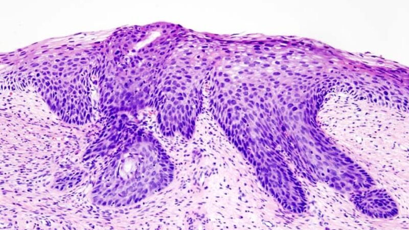 A vacina do HPV já aparece na conta do SUS — lesão pré-câncer em adolescente caiu 78%