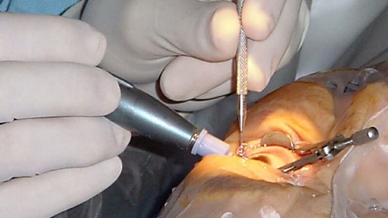 O SUS vai tratar catarata e glaucoma na mesma cirurgia — e ainda economizar